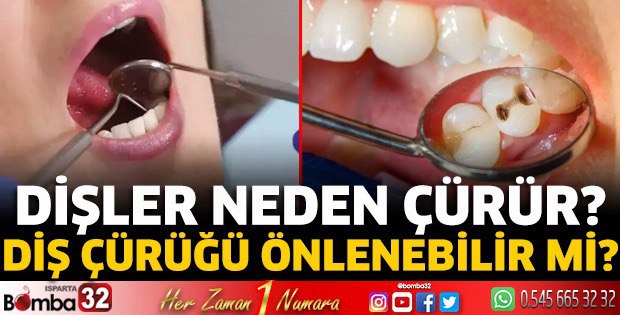  İl Sağlık Müdürlüğü duyurdu: Dişler neden çürür?