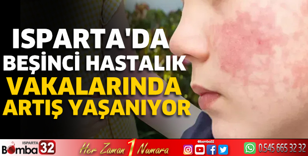 Isparta'da beşinci hastalık vakalarında artış yaşanıyor
