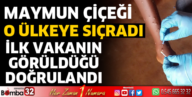 İsveç'te maymun çiçeği vakası doğrulandı
