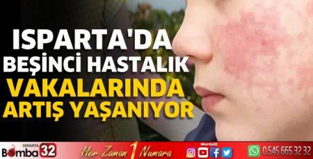 Isparta'da beşinci hastalık vakalarında artış yaşanıyor