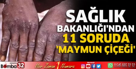 Sağlık Bakanlığı'ndan 11 soruda 'maymun çiçeği'