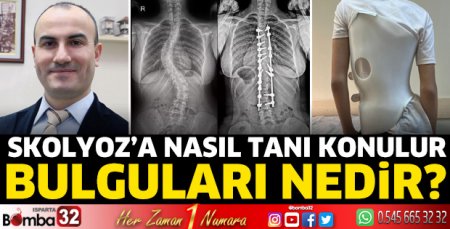 Skolyoz'a nasıl tanı konulur?